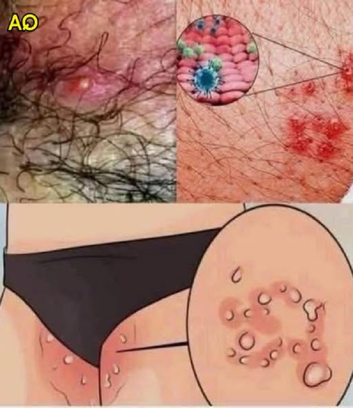 What Is HPV? Key Facts You Should Know